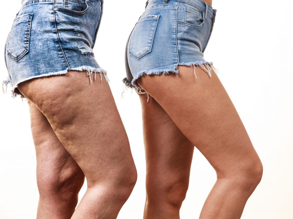 Trusculpt™ Reduces Cellulite and Sculpts Your Body Better Than Coolsculpting Trusculpt™ Reduces Cellulite and Sculpts Your Body Better Than Coolsculpting