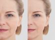 Best Treatments for Eye Wrinkles