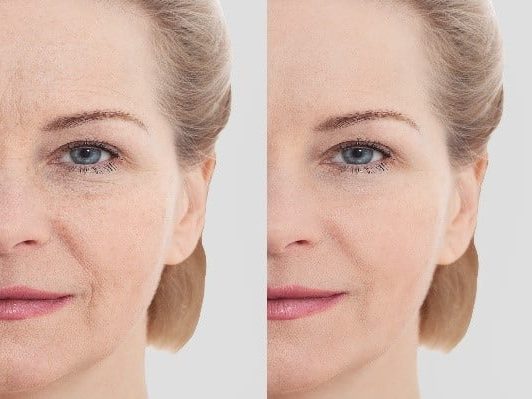 Best Treatment for Eye Wrinkles Best Treatments for Eye Wrinkles