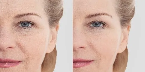 Best Treatments for Eye Wrinkles