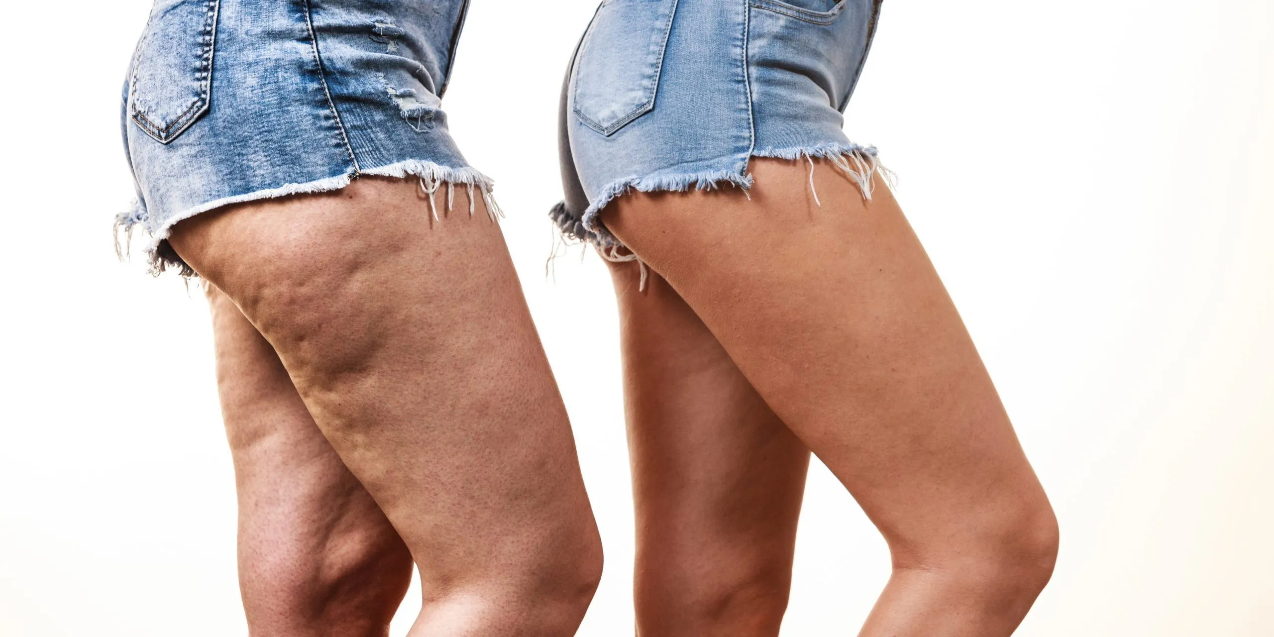 What is Venus Legacy? How Does it Help with Fat Reduction?