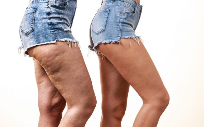 What is Venus Legacy? How Does it Help with Fat Reduction?