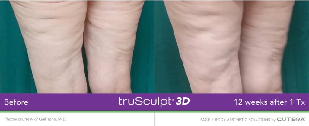 Body Sculpting Get Trusculpt® 3d At Our Medical Spa In Simsbury